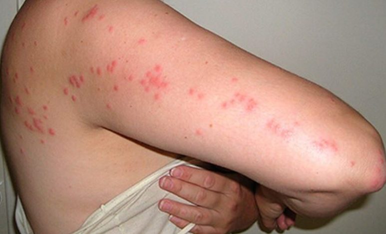 Bed bugs rash Bed bugs rash